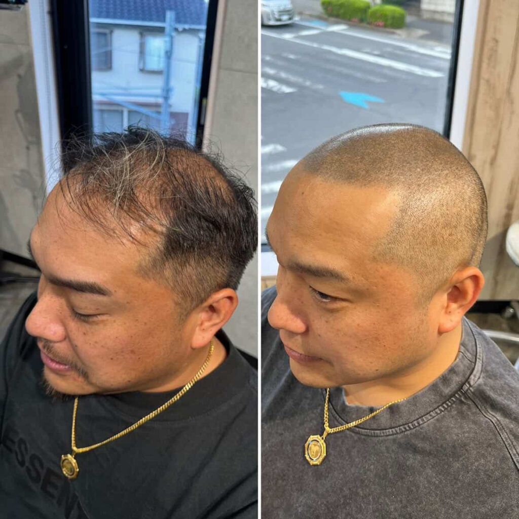薄毛の男性のビフォーアフター
