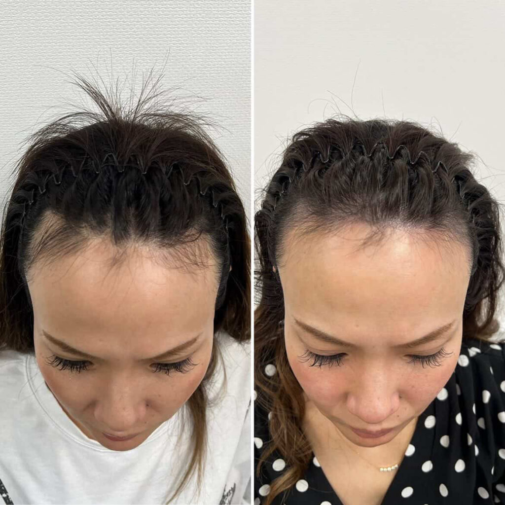生え際が気になる女性のビフォーアフター
