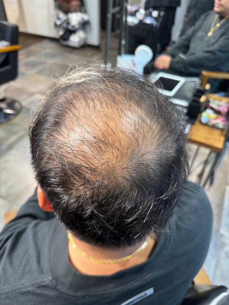 スカルプインク施術前の男性